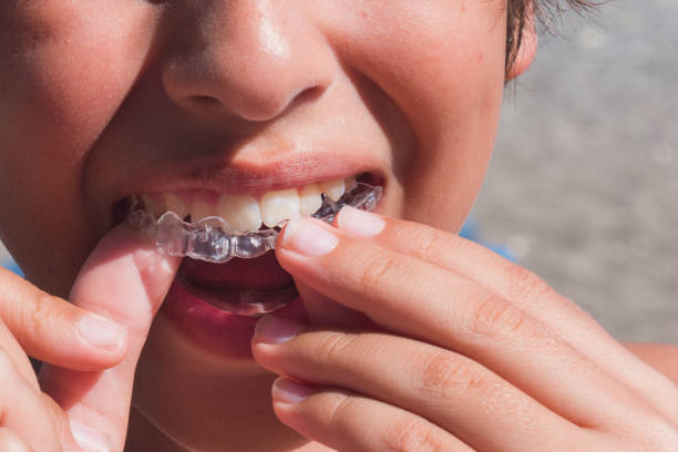 Invisalign Braces are Exactly What Your Smile Needs