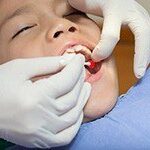 Wisdom Tooth Extraction