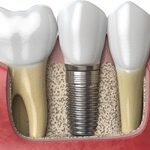 Indications For Dental Implants