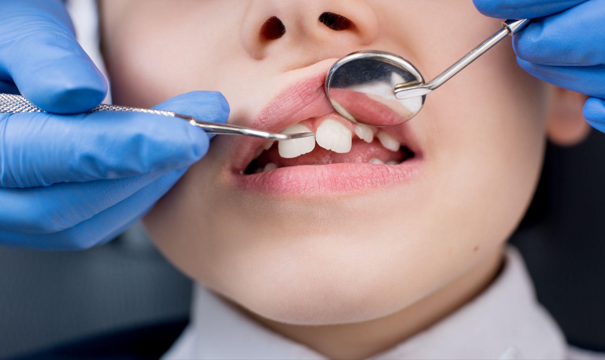 A dentist checking the teeth of a young kid, making sure there is no damage.
